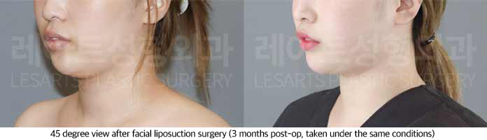 facial_liposuction_02_05_250703