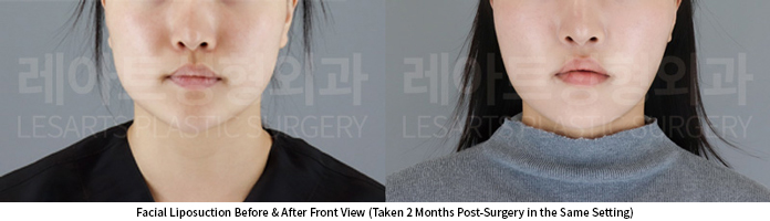 facial_liposuction_02_06_250626