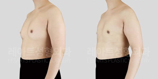 gynecomastia_01_thumbnail_250430