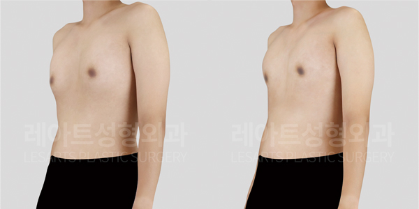 gynecomastia_01_thumbnail_250509