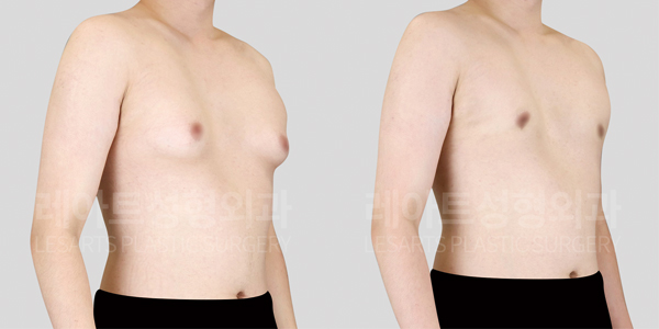 gynecomastia_01_thumbnail_250514