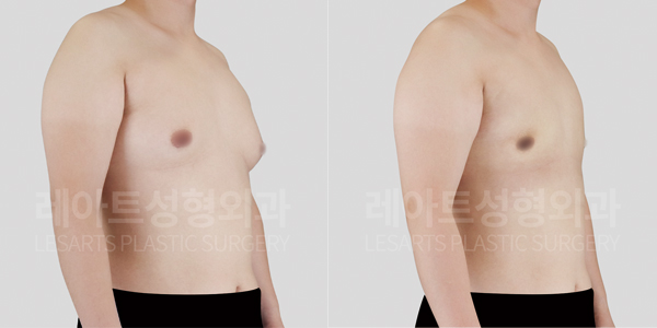 gynecomastia_01_thumbnail_250521