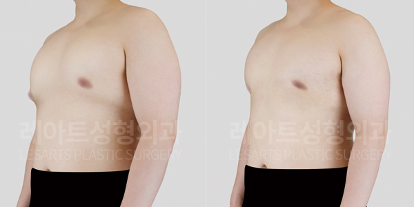 gynecomastia_01_thumbnail_250527