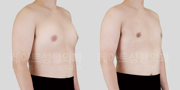 gynecomastia_01_thumbnail_250604
