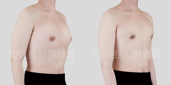 gynecomastia_01_thumbnail_250611