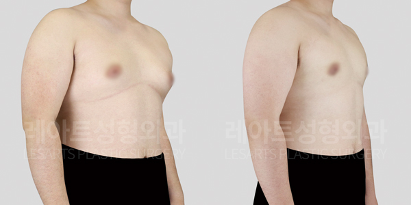 gynecomastia_01_thumbnail_250618