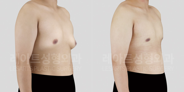 gynecomastia_01_thumbnail_250625