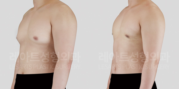 gynecomastia_01_thumbnail_250702