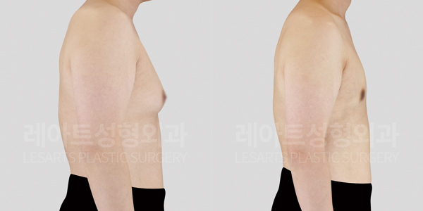 gynecomastia_01_thumbnail_250704
