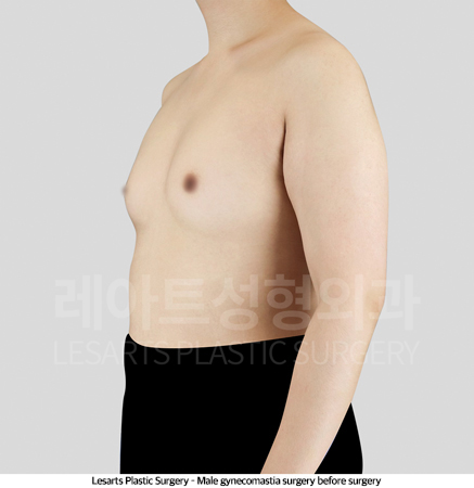 gynecomastia_02_01_250430