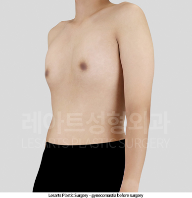 gynecomastia_02_01_250509