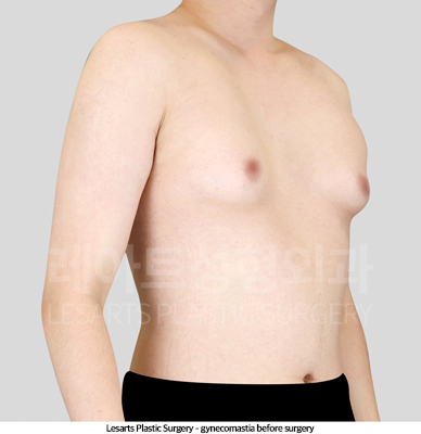 gynecomastia_02_01_250514