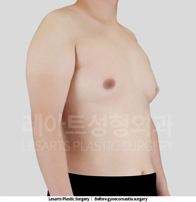 gynecomastia_02_01_250521