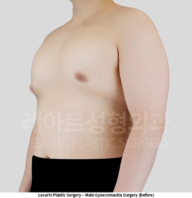 gynecomastia_02_01_250527