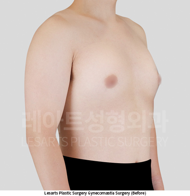 gynecomastia_02_01_250604