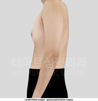 gynecomastia_02_02_250509
