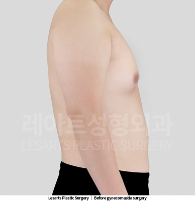 gynecomastia_02_02_250521