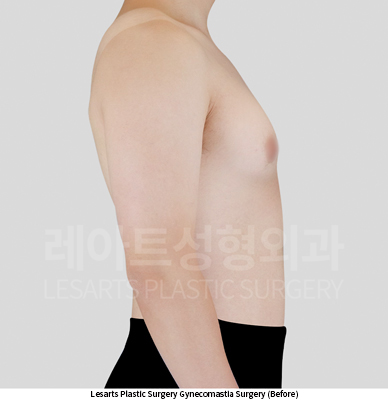 gynecomastia_02_02_250604