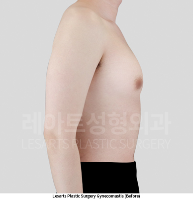 gynecomastia_02_02_250611