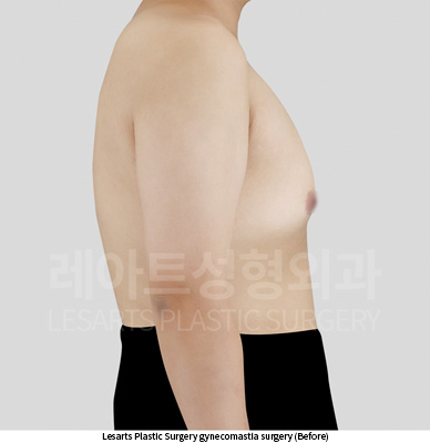 gynecomastia_02_02_250625