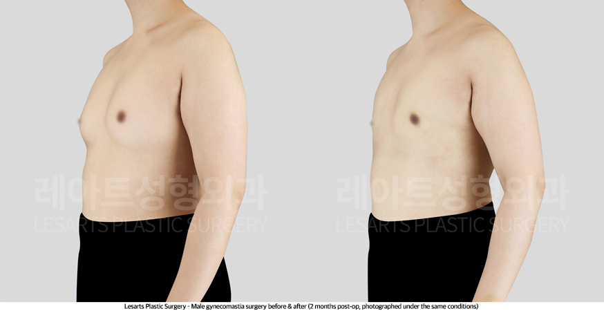 gynecomastia_02_03_250430