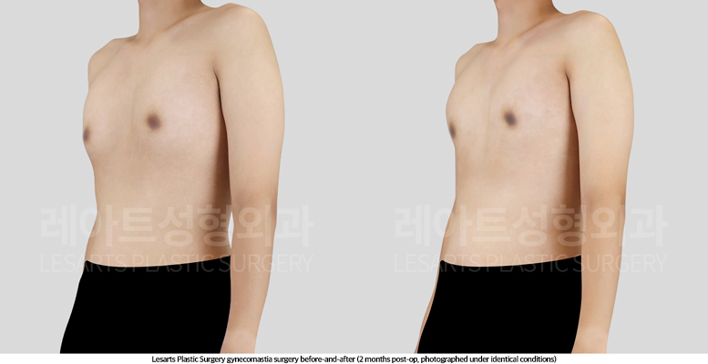 gynecomastia_02_03_250509
