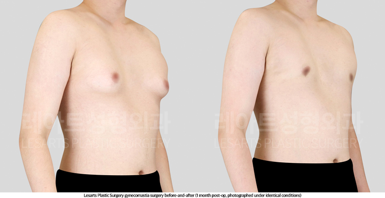 gynecomastia_02_03_250514