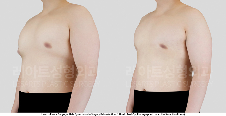 gynecomastia_02_03_250527