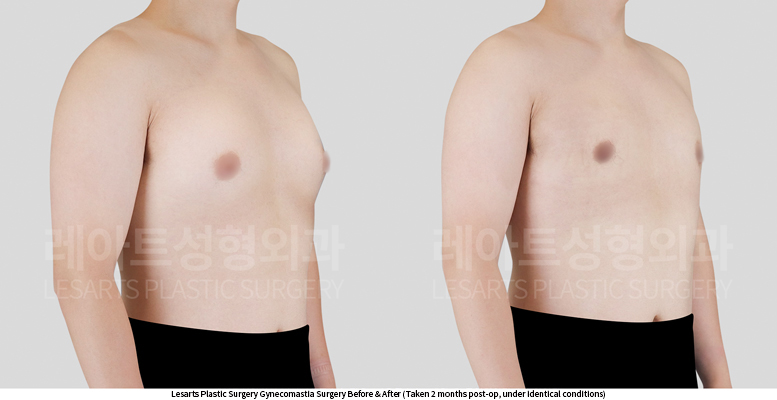 gynecomastia_02_03_250604