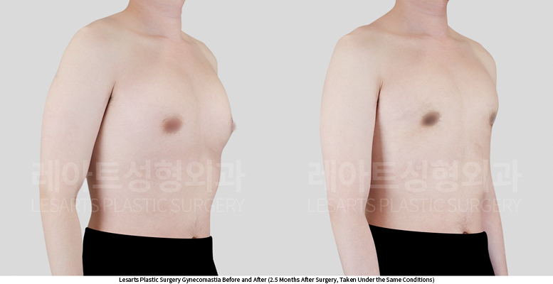 gynecomastia_02_03_250611
