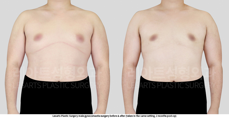 gynecomastia_02_03_250618