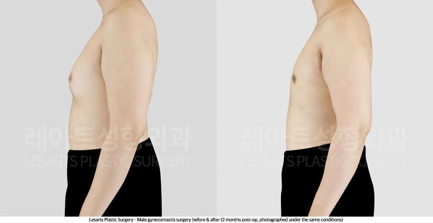 gynecomastia_02_04_250430