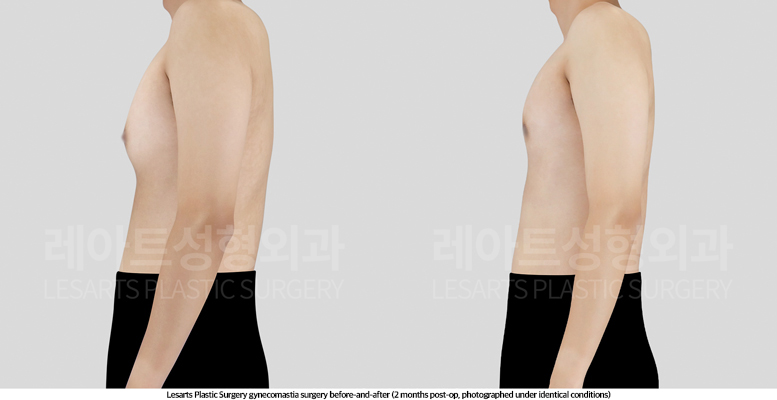 gynecomastia_02_04_250509