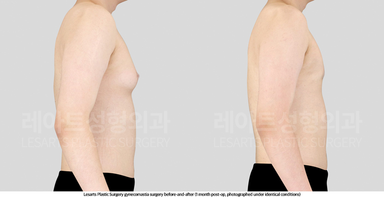 gynecomastia_02_04_250514