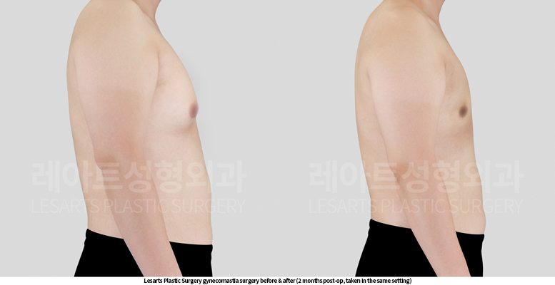 gynecomastia_02_04_250521