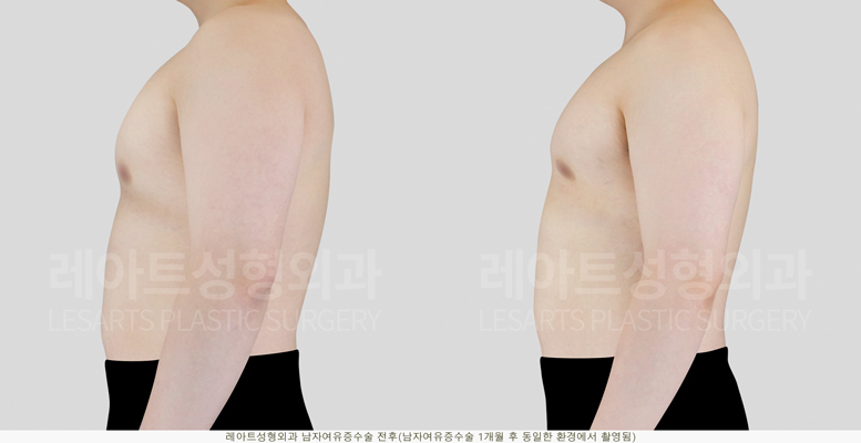 gynecomastia_02_04_250527
