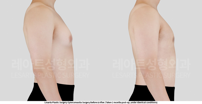 gynecomastia_02_04_250604