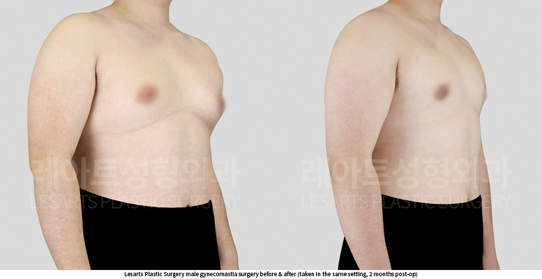 gynecomastia_02_04_250618