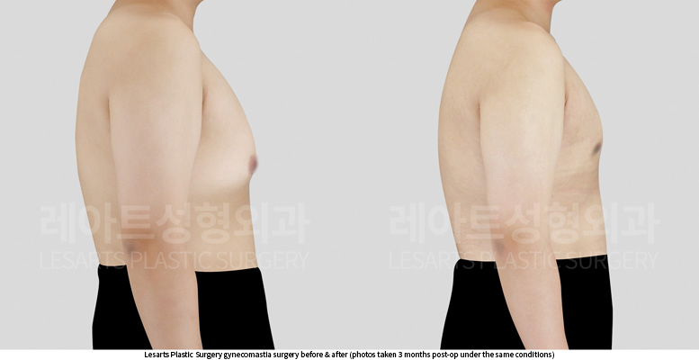 gynecomastia_02_04_250625