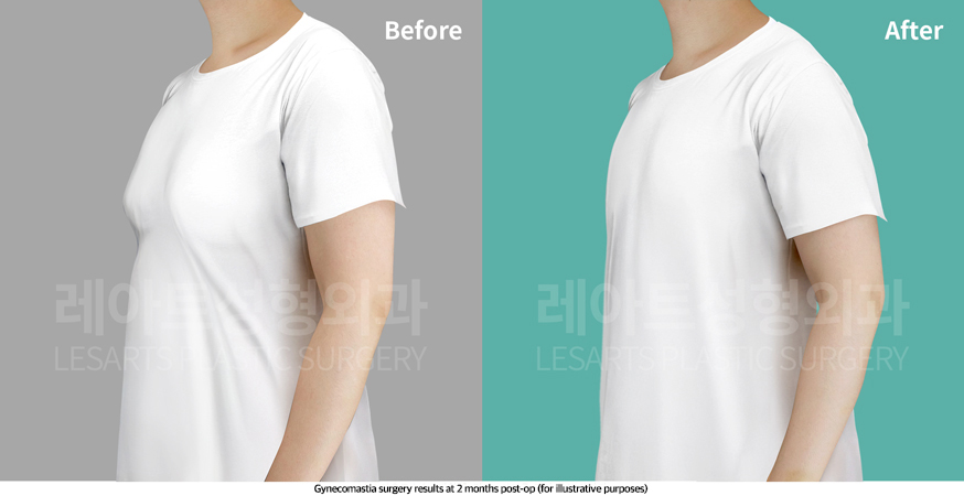 gynecomastia_02_05_250430