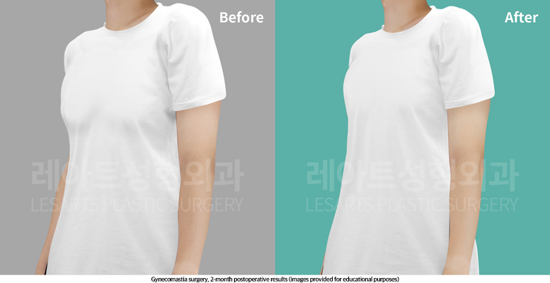 gynecomastia_02_05_250509