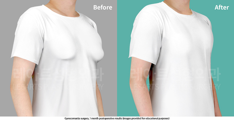 gynecomastia_02_05_250514