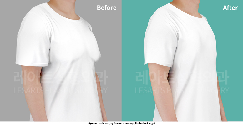 gynecomastia_02_05_250521