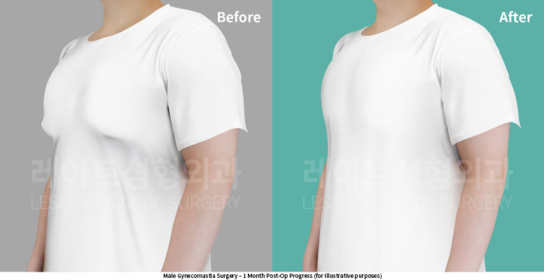gynecomastia_02_05_250527
