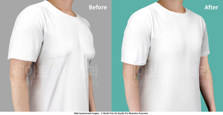 gynecomastia_02_05_250704