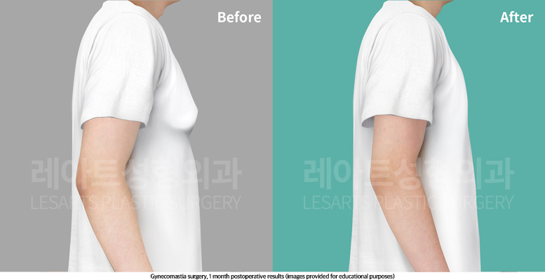 gynecomastia_02_06_250514