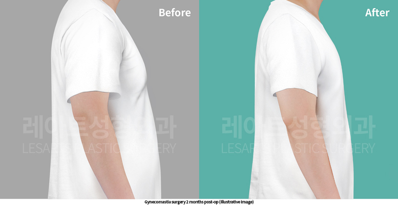 gynecomastia_02_06_250521