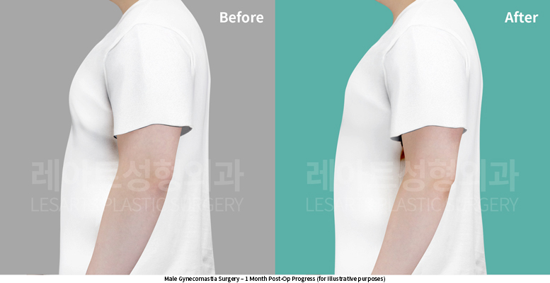 gynecomastia_02_06_250527