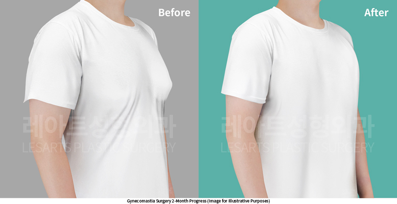 gynecomastia_02_06_250604