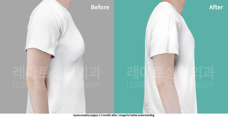 gynecomastia_02_06_250611
